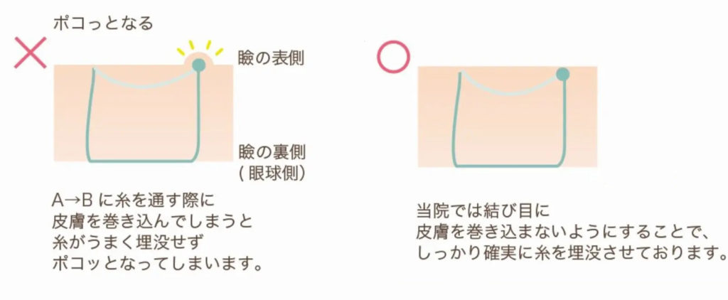 二重埋没法の縫合成功と失敗例