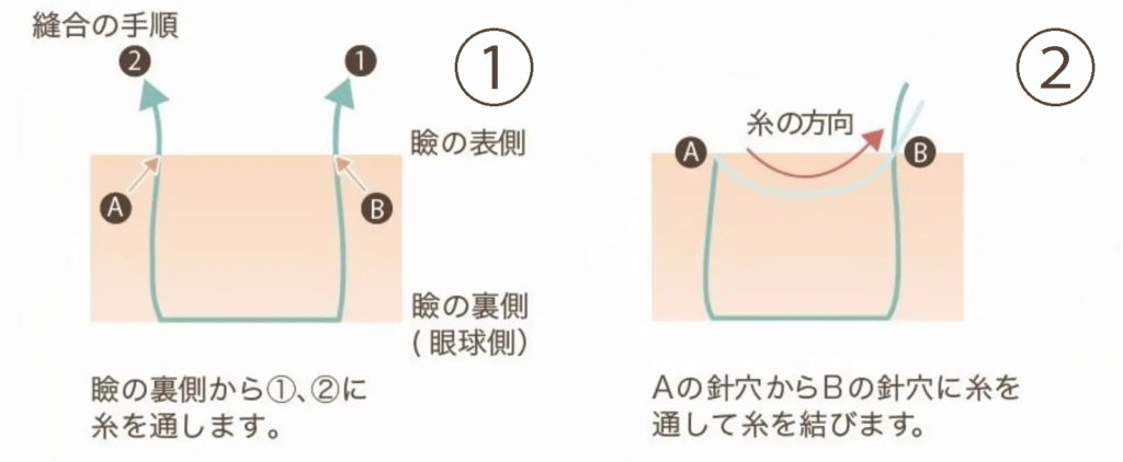 二重埋没法の縫合手順①②