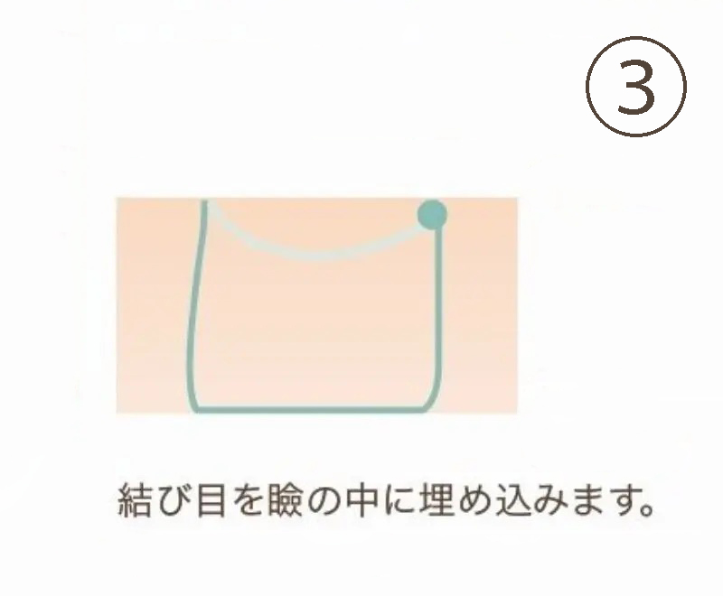 二重埋没法の縫合手順③