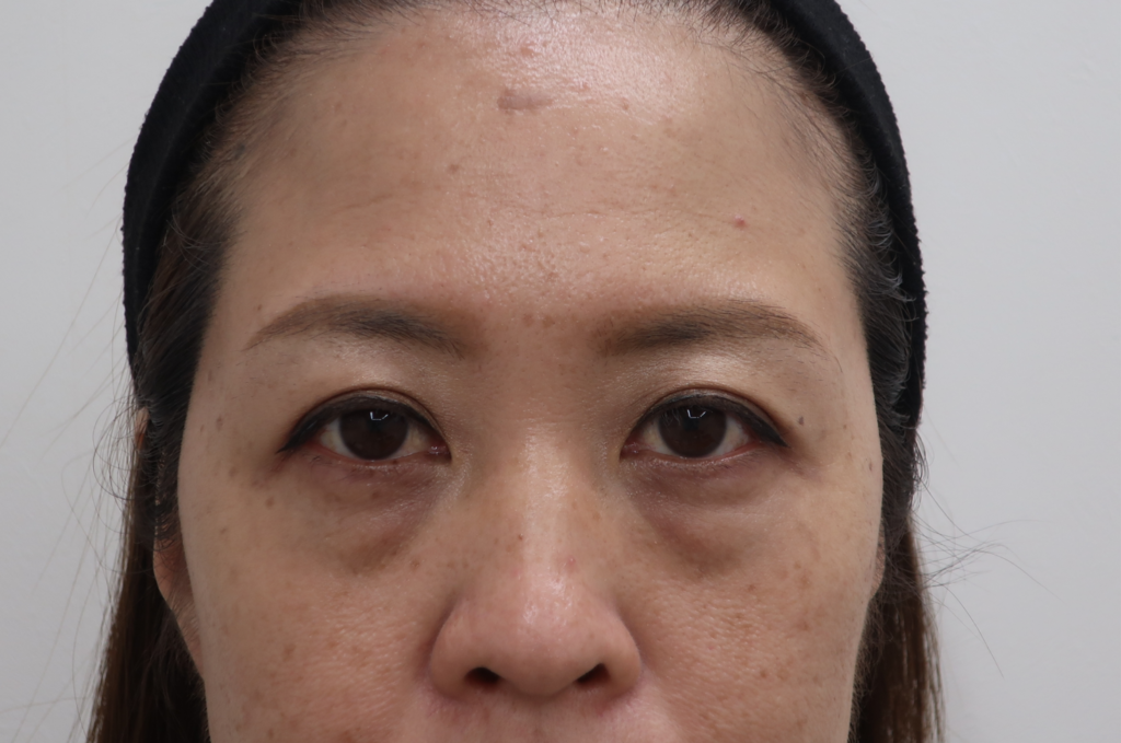 涙袋のヒアルロン酸注入における失敗事例と原因 美容整形で失敗しないための秘訣 水の森美容外科