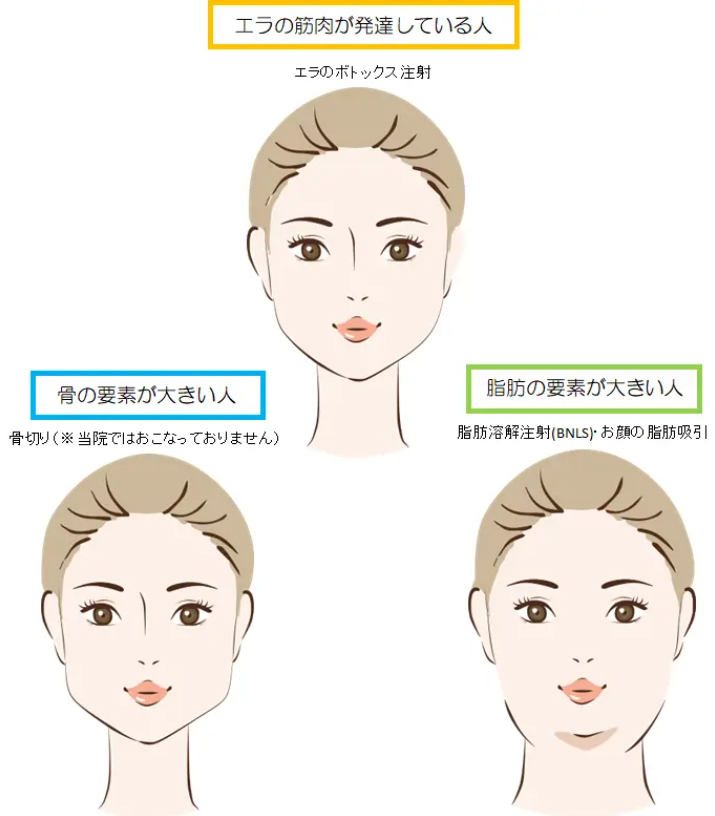 エラのボトックス注射をしたが変化が無く 効果を実感できなかった 美容整形の失敗しないために 水の森美容外科