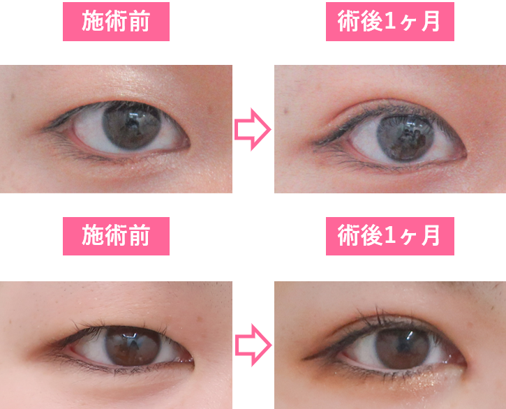 瞼の厚みは本当に脂肪ですか 瞼の脂肪 取り をすれば厚みは解消されますか 美容整形の裏事情 美容整形で失敗しないための秘訣 美容整形の失敗と美容外科の裏事情 水の森美容外科