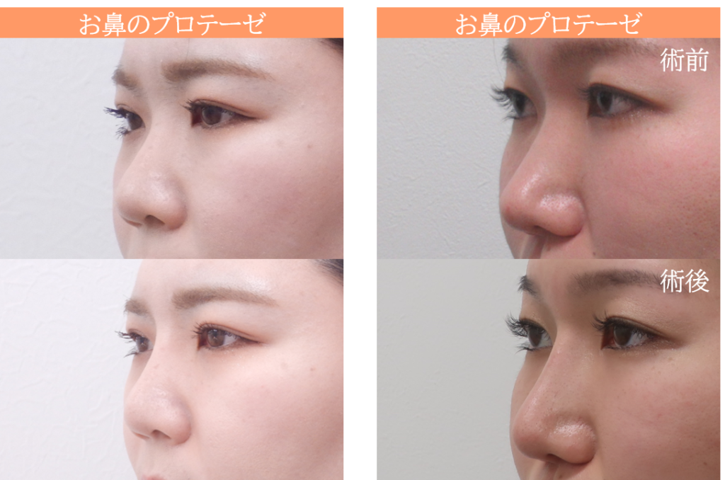 鼻のプロテーゼの症例写真