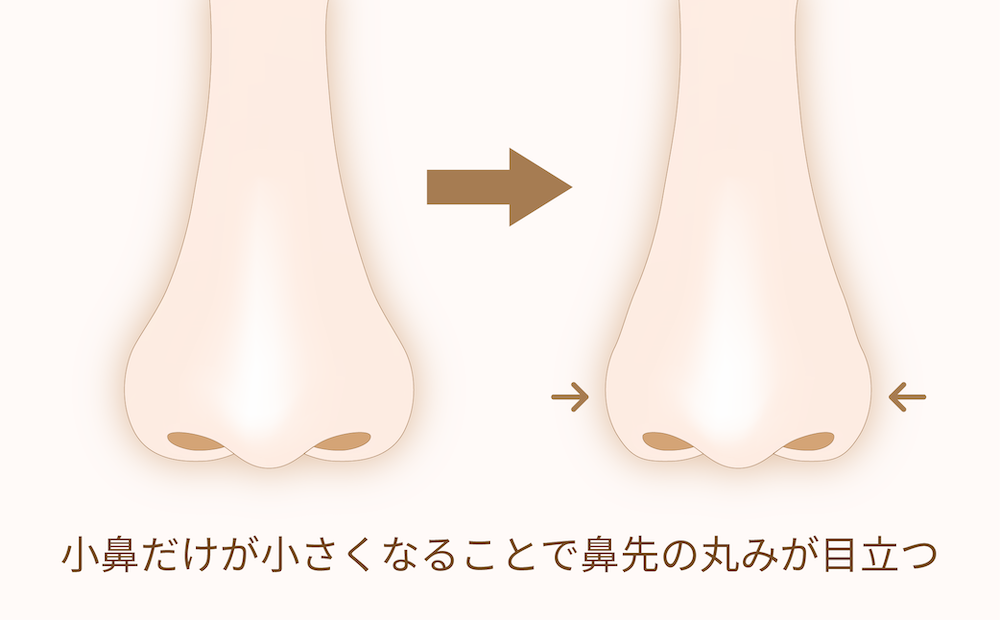 小鼻が小さくなることで鼻先の丸みが目立つ図