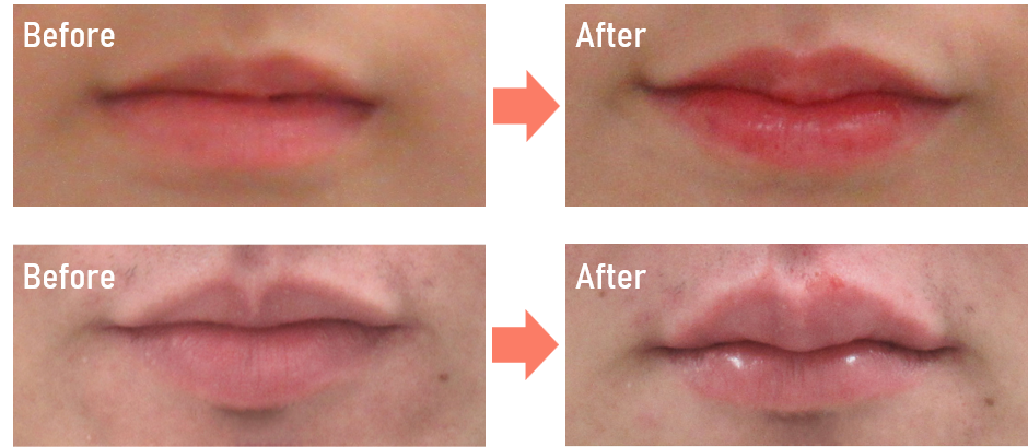 唇のヒアルロン酸注入の症例写真