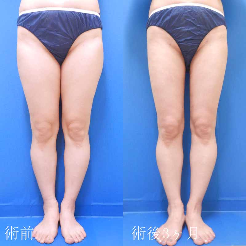 太ももの脂肪吸引の症例写真