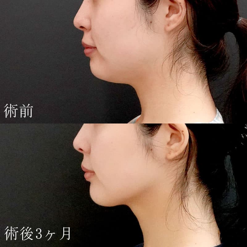 顔の脂肪吸引の症例写真