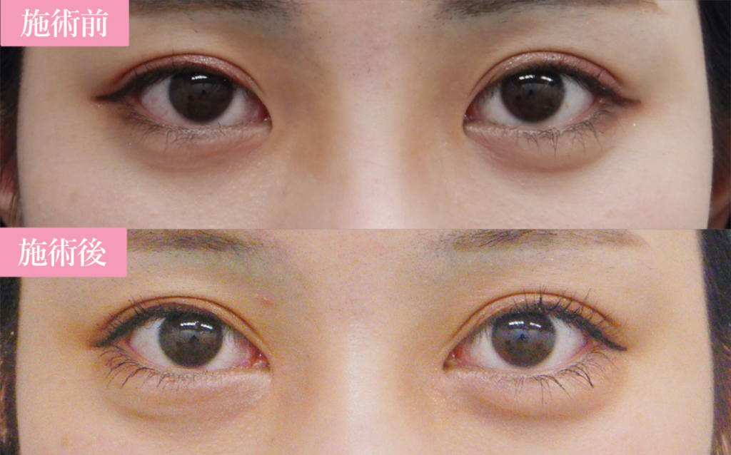 目頭切開の抜糸は何日後 痛い 麻酔の有無や術後のダウンタイムについて 美容整形の裏事情