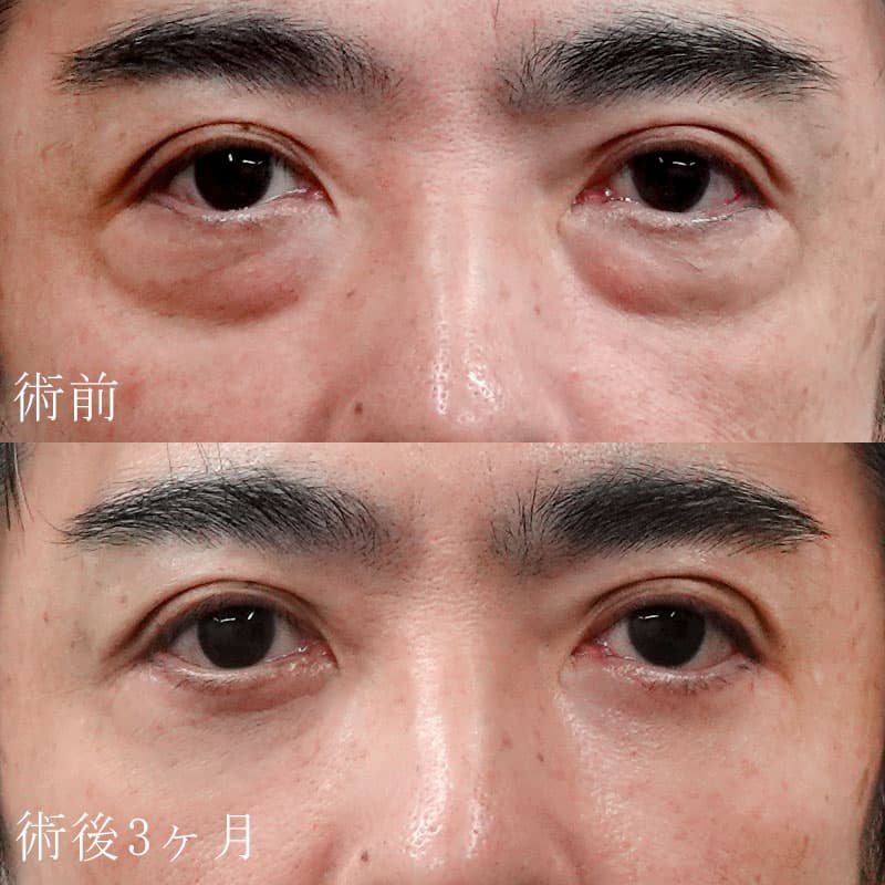目の下のクマ・たるみ取り（ハムラ法）の東京銀座院鈴木院長の症例
