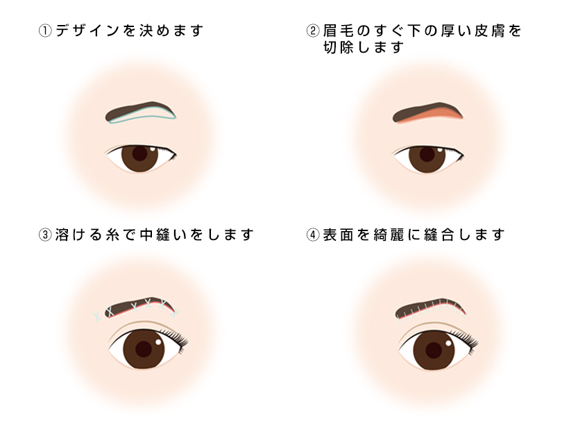 眉下切開の手術方法