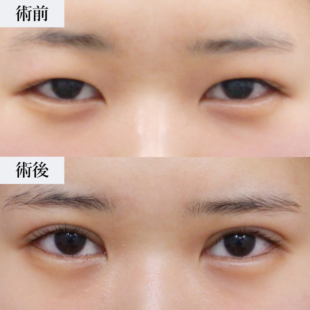 眼瞼下垂手術での失敗例と後悔しないためのポイント｜美容整形で失敗しないために【水の森美容外科】