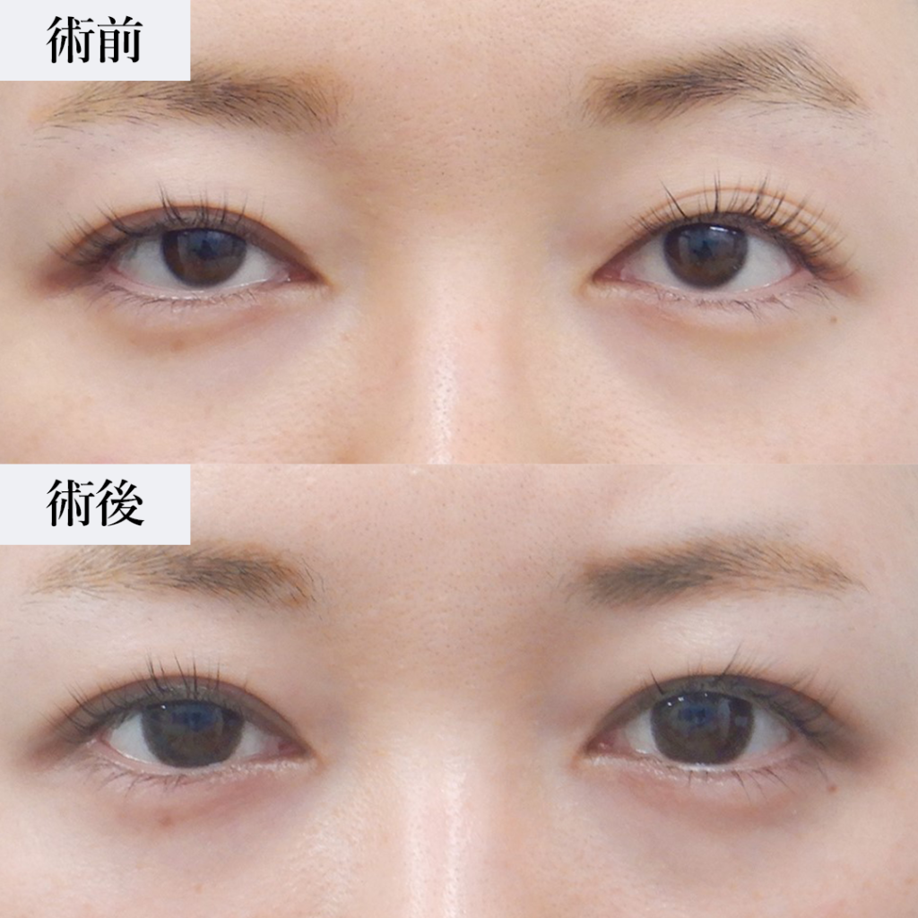 眼瞼下垂のダウンタイムはどのくらい?術後経過と長引せないためのポイントを解説|水の森美容クリニック