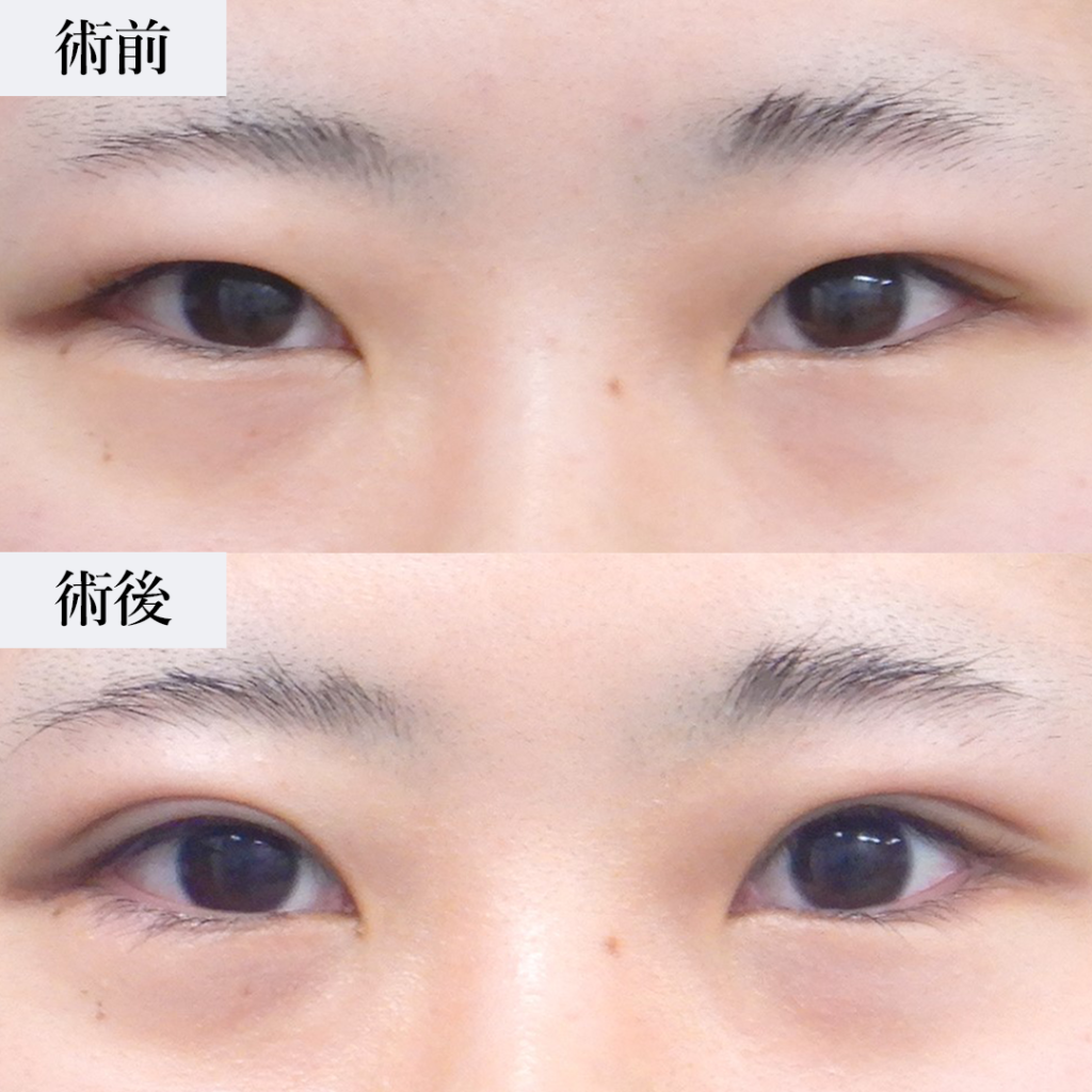 難易度の高い眼瞼下垂修正と全切開の一例。｜画像･費用｜美容整形･美容外科のTAクリニックグループ