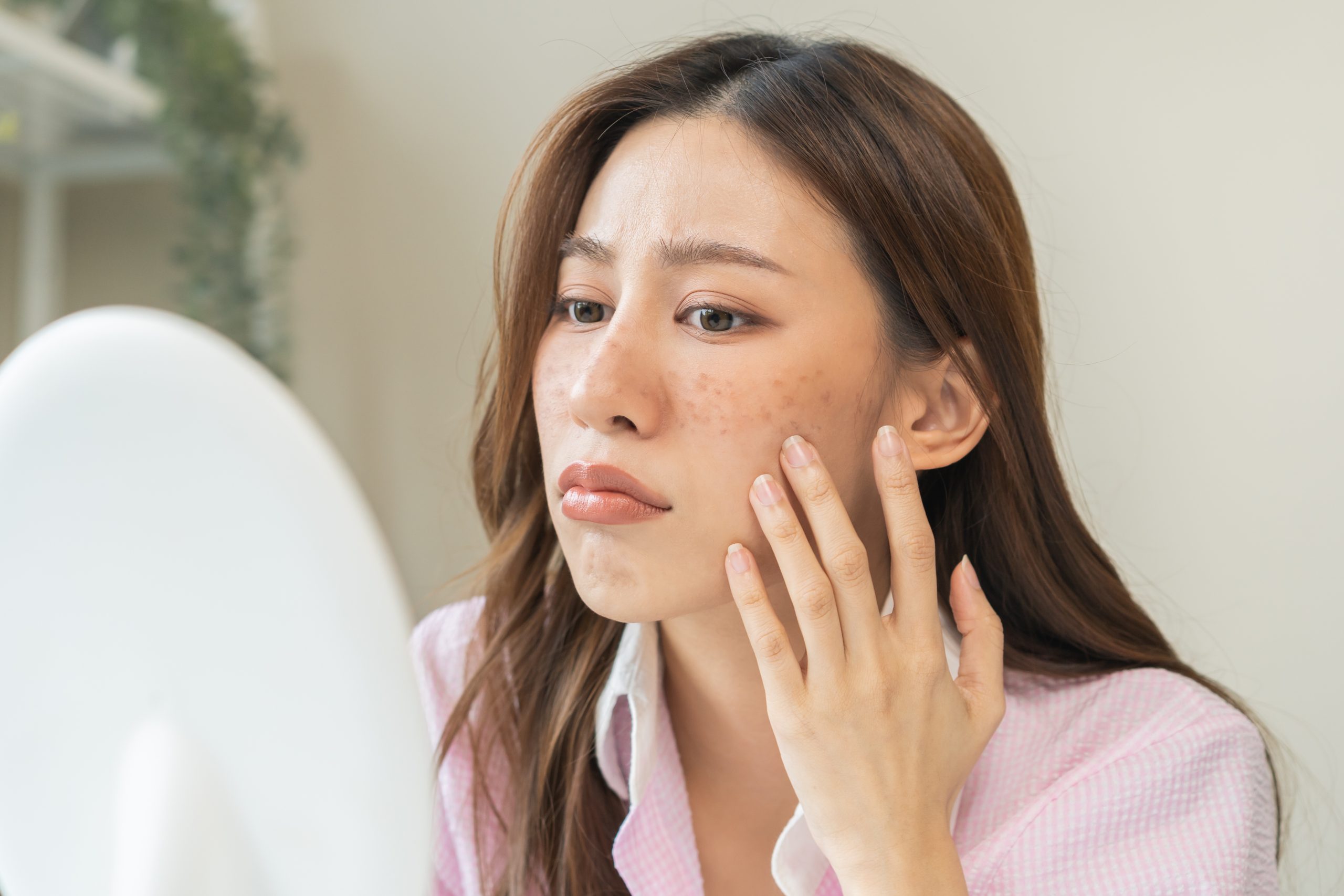 ニキビ跡の治し方・赤みを消す方法【美容皮膚科解説 】｜水の森