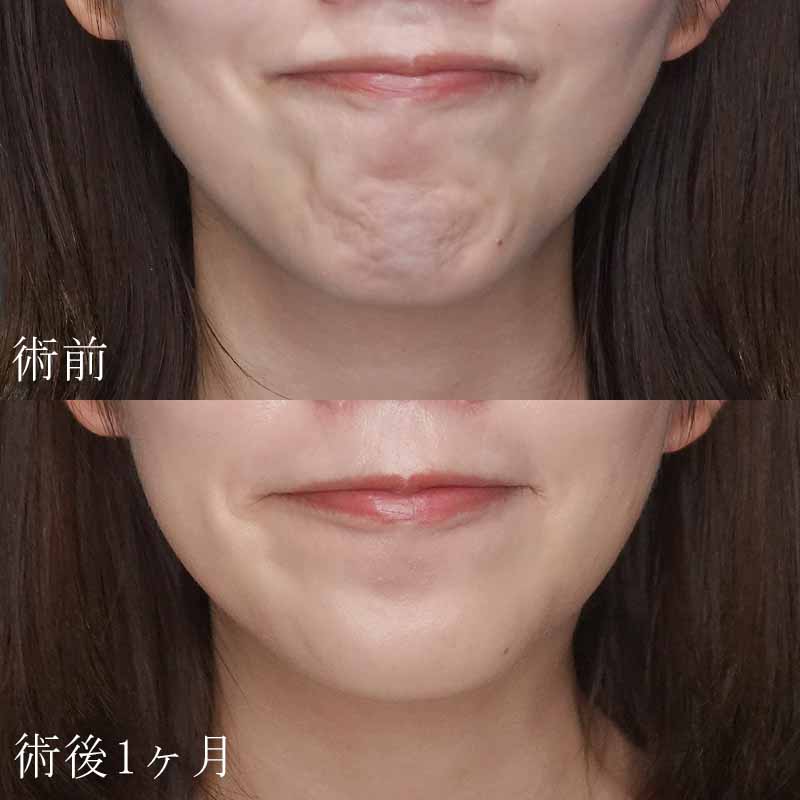 顎ボトックス注射の症例写真
