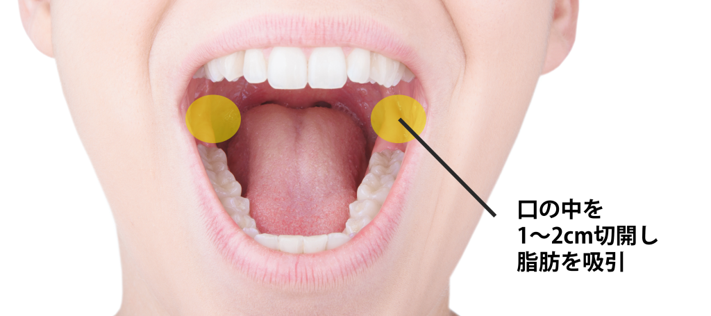 バッカルファットの施術位置