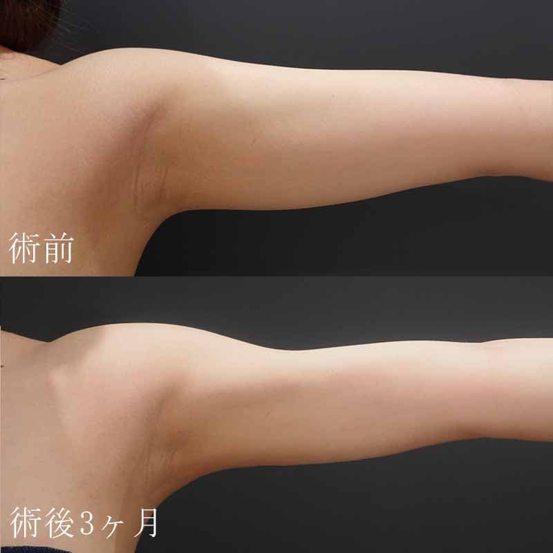 二の腕の脂肪吸引の施術症例写真②