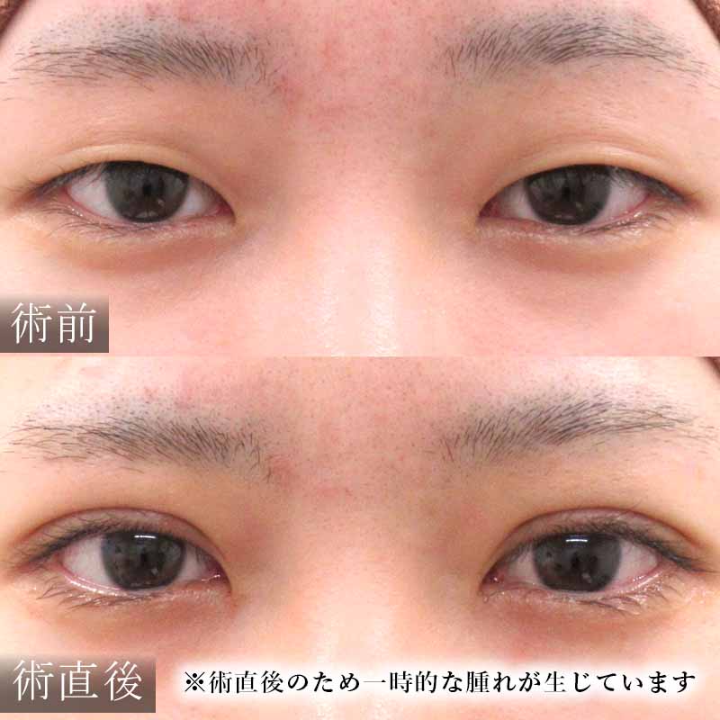 東京新宿院岡田医師の二重埋没法症例画像