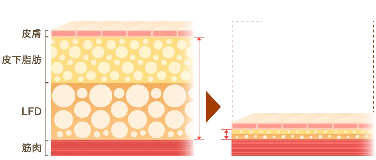 脂肪吸引の術後のイメージ