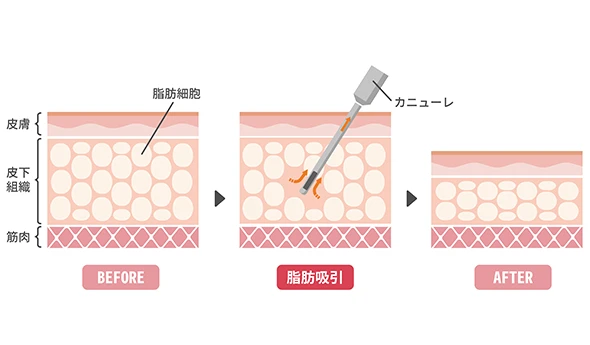 脂肪吸引の仕組み