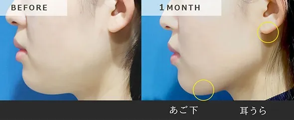 フェイスラインの脂肪吸引の傷跡
