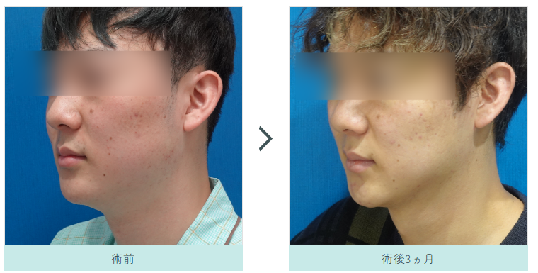 男性の顔の脂肪吸引施術写真（横顔）
