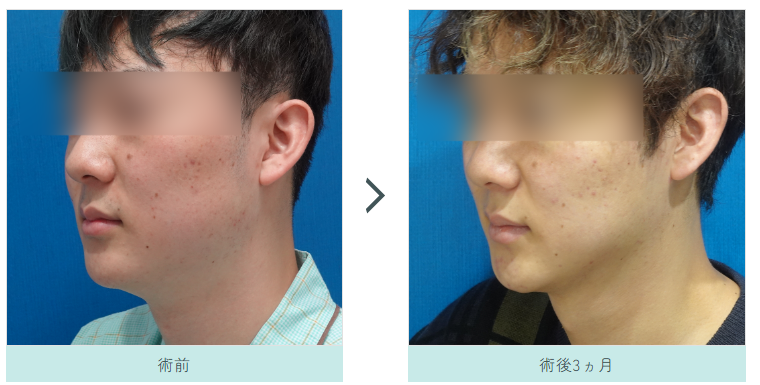 顔の脂肪吸引の症例写真