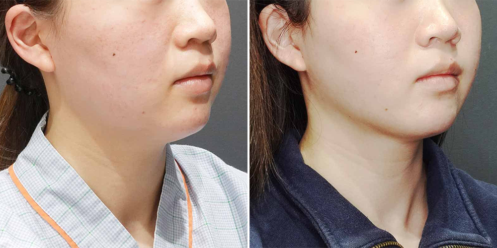 顔（頬＋顎下）の脂肪吸引の症例写真＿東京竹村先生①