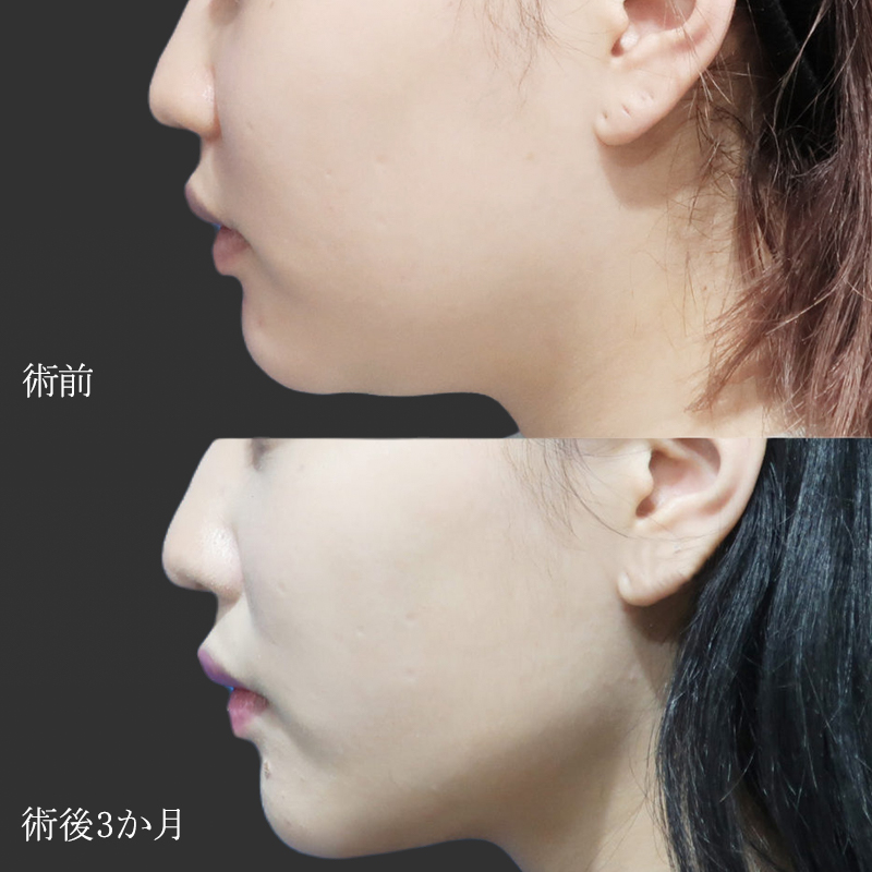 顔（頬＋顎下）の脂肪吸引の症例写真＿東京鈴木先生①横