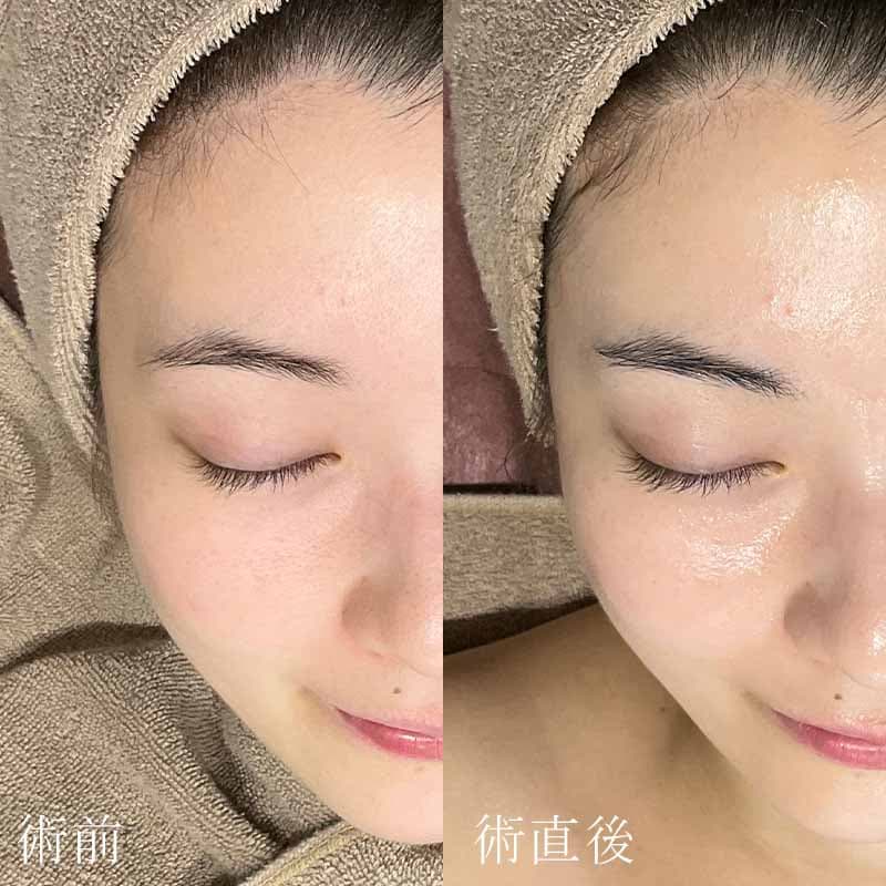 エレクトロポレーションは効果ない？たるみや肝斑への効果や頻度 