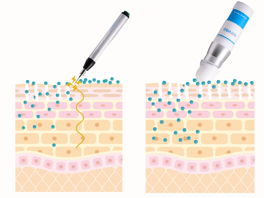 エレクトロポレーションは効果ない？たるみや肝斑への効果や頻度（やりすぎ注意）｜水の森美容クリニック 美容皮膚科｜