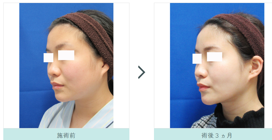 顔の脂肪吸引とエラのボトックスの症例写真