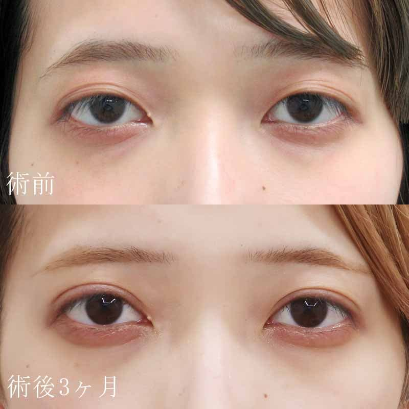 岡田医師の二重切開法症例写真①