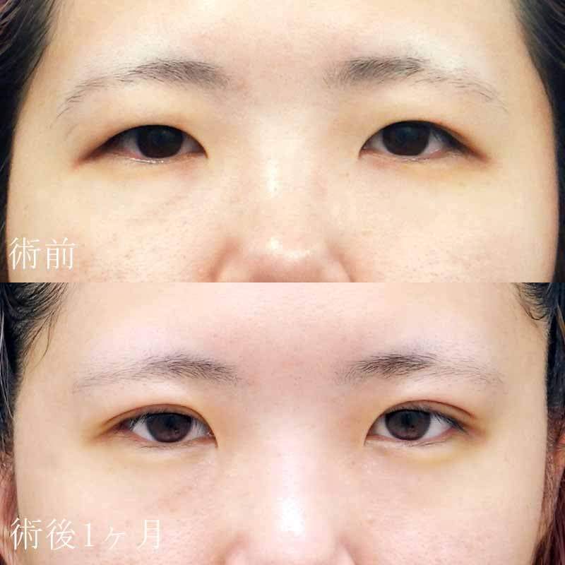 岡田医師の二重切開法症例写真②