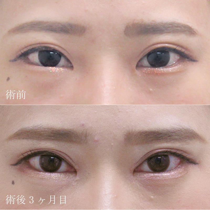 竹村院長の目頭切開症例写真①