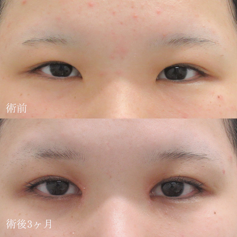 石原医師の目頭切開症例写真②