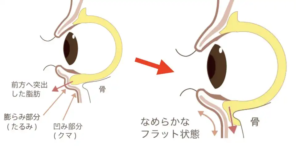 ハムラ法（目の下のたるみ取りの施術方法）