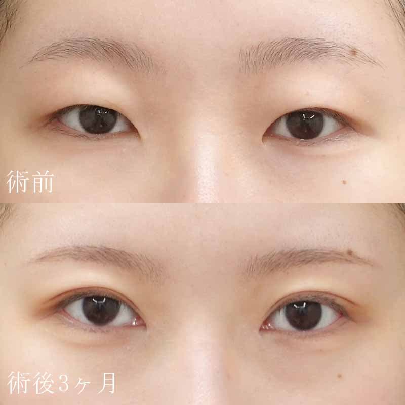 鈴木院長の二重切開+目頭切開の症例写真②