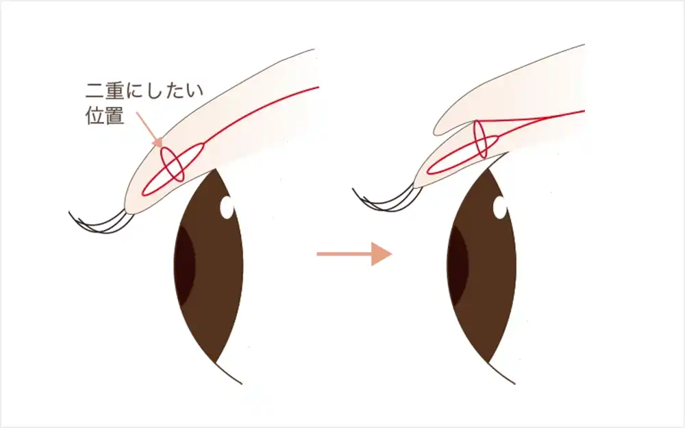 二重埋没法の仕組み