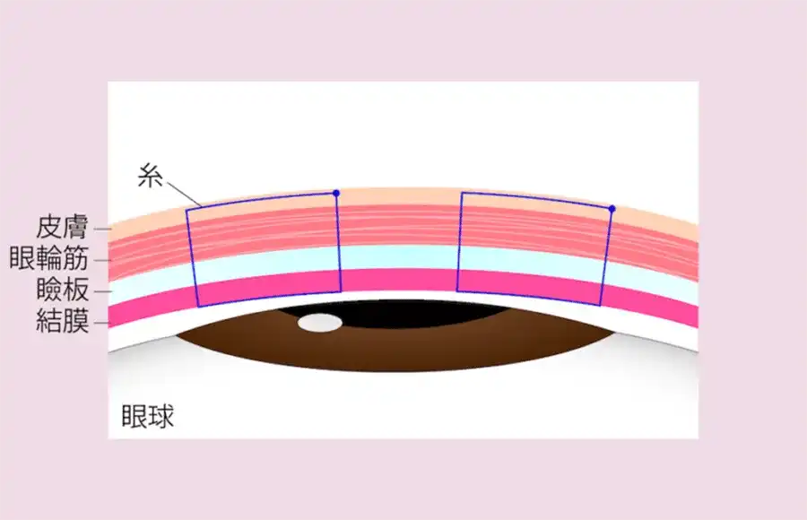 当院では瞼板法で二重埋没を行う