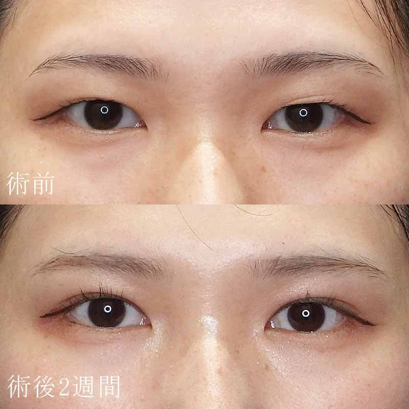 二重埋没法の症例写真①