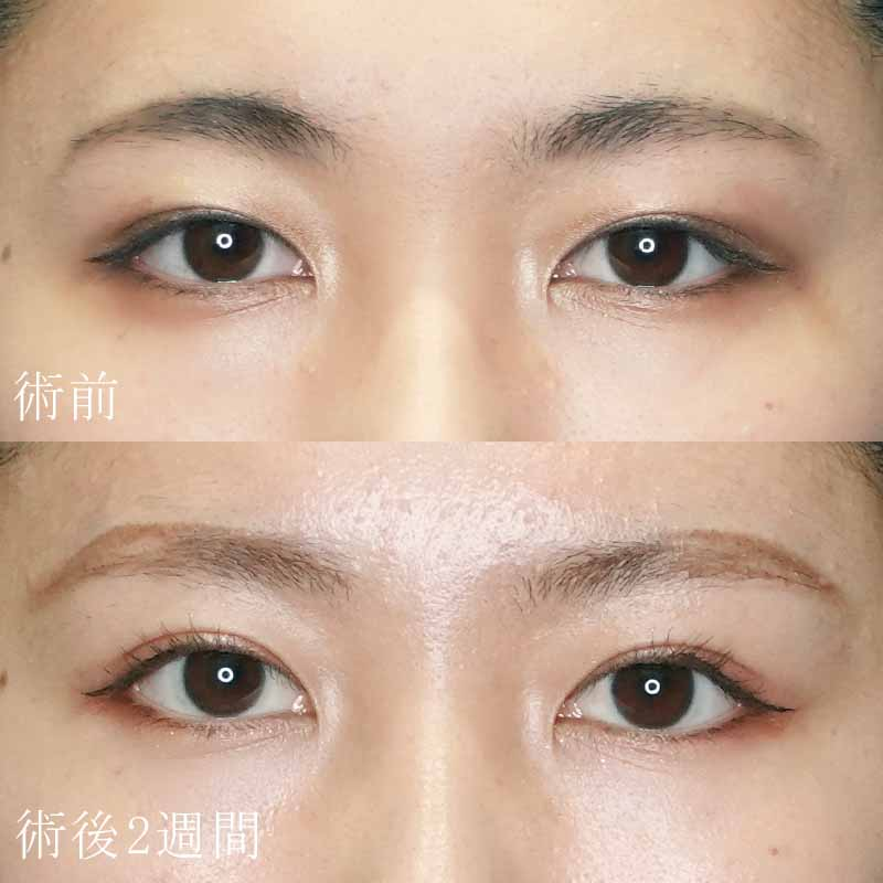二重埋没法の症例写真③