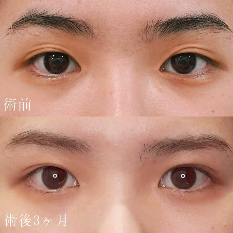 二重切開法の症例写真②