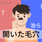 毛穴の開きは改善できる？原因や最適な治療法について解説