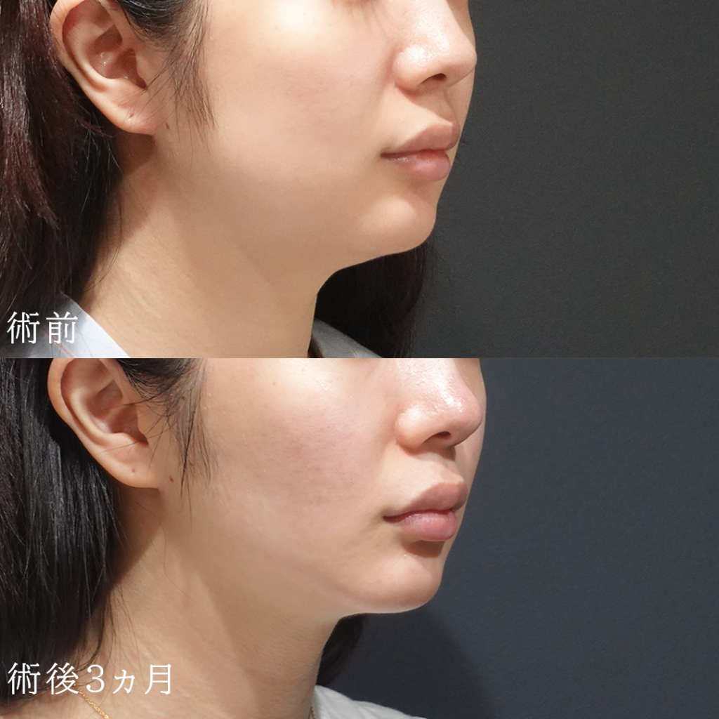 下膨れ顔を解消する美容整形４つを解説！脂肪吸引などのメリットとデメリットもご紹介
