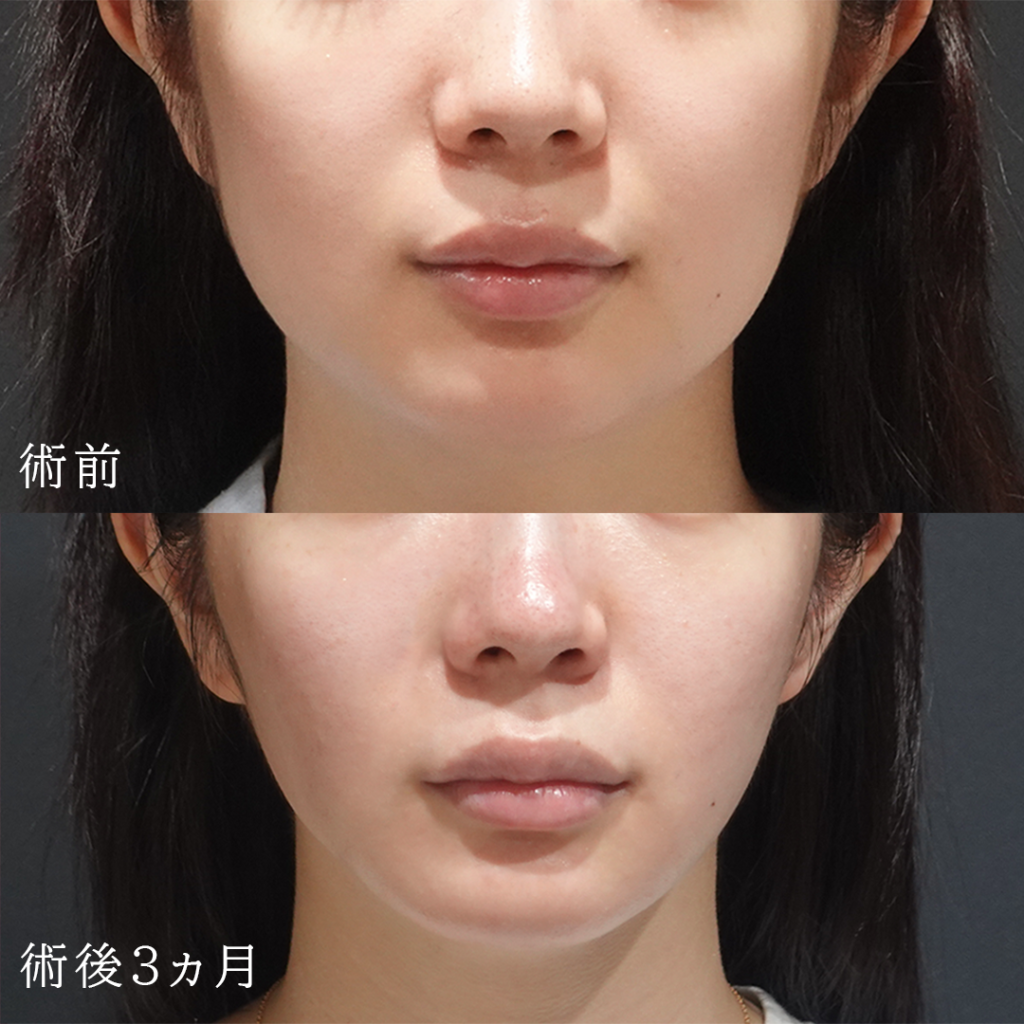下膨れ顔を解消する美容整形４つを解説！脂肪吸引などのメリットとデメリットもご紹介