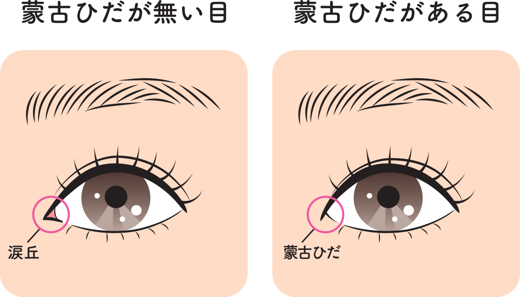 離れ目を治す美容整形について解説！メイクでもカバーできない時は目頭切開｜水の森美容クリニック