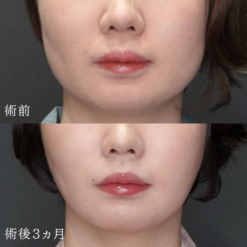 顔の脂肪吸引の症例写真－銀座院竹村先生