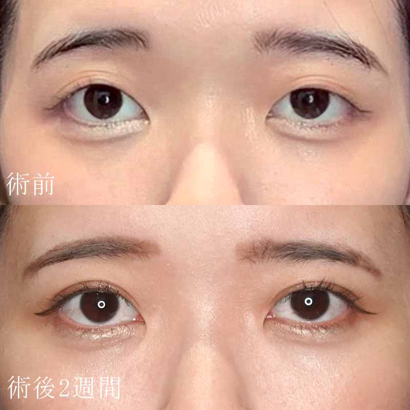 杉山医師の二重埋没法+涙袋ヒアルロン酸注入症例写真
