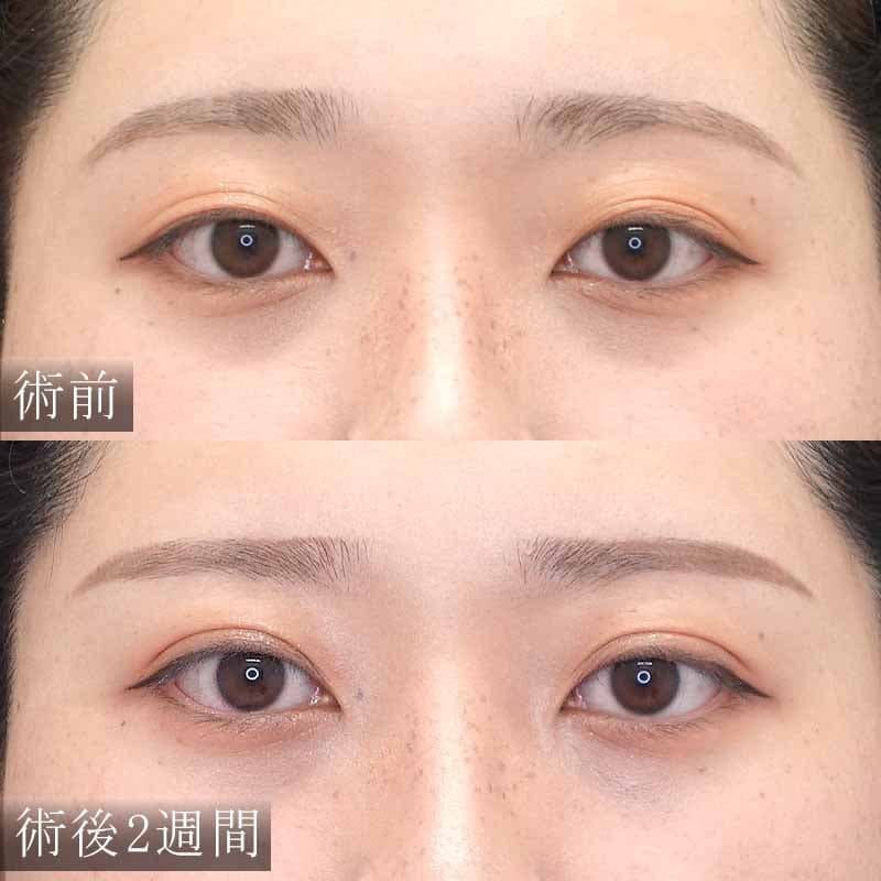 二重埋没法の症例写真